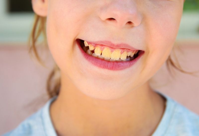 Cao răng là lớp cứng hình thành trên bề mặt răng khi mảng bám không được vệ sinh kịp thời hoặc đúng cách.