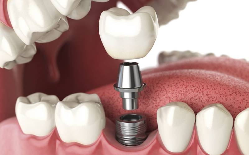Giá cấy ghép Implant bằng nào