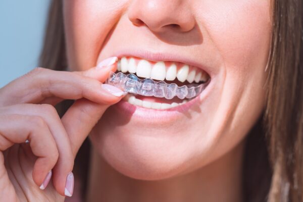 Khay niềng trong suốt có mức chi phí khá cao.