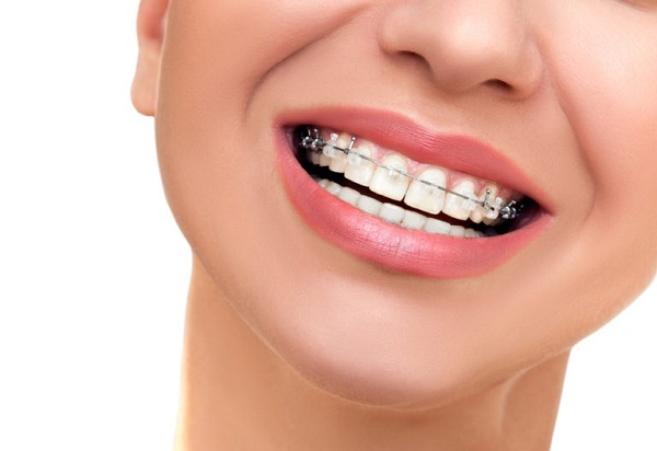 Tùy vào mắc cài mà mức giá niềng sẽ có sự dao động.