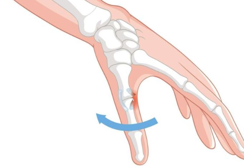 biến chứng khi bị trật khớp ngón tay