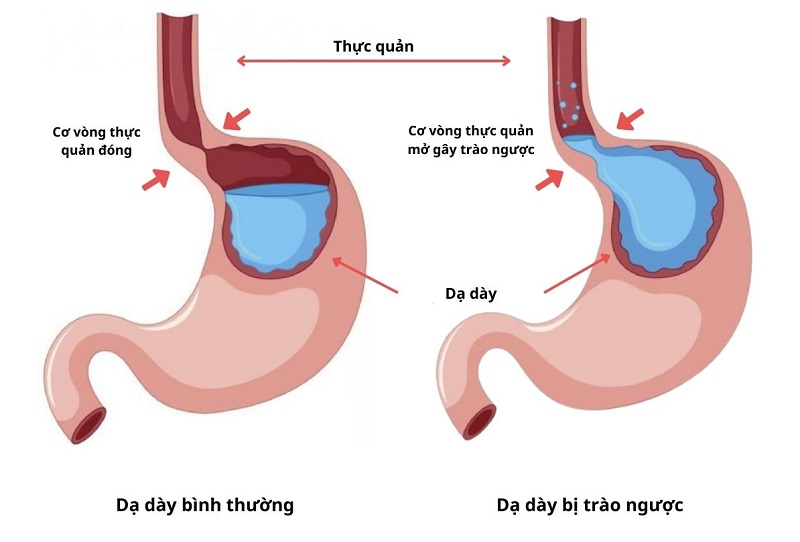Hội chứng trào ngược dạ dày thực quản là gì?