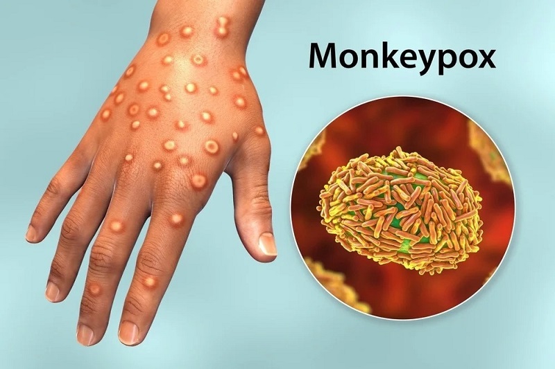 Mụn đậu mùa khá giống với mụn thủy đậu