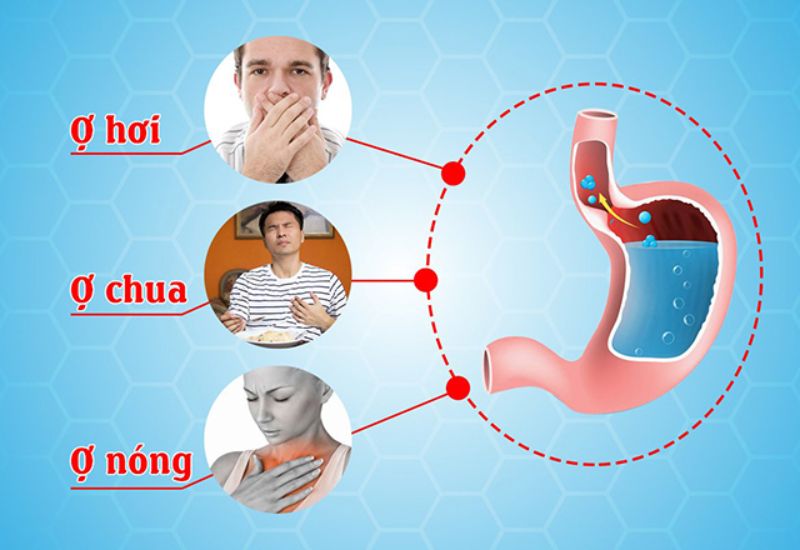 Nguyên nhân gây ra các triệu chứng ợ hơi, ợ nóng, ợ chua