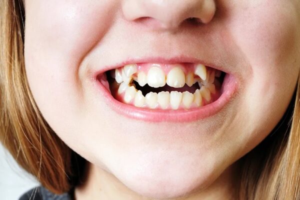 Theo nhiều người, răng khểnh không đẹp và cần được cân chỉnh lại.