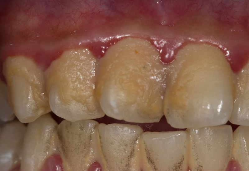 Giải đáp chi tiết thắc mắc: Sâu răng như thế nào?
