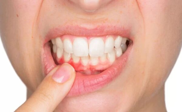 Sưng nướu là tình trạng khá phổ biến và có nhiều nguyên nhân gây ra.