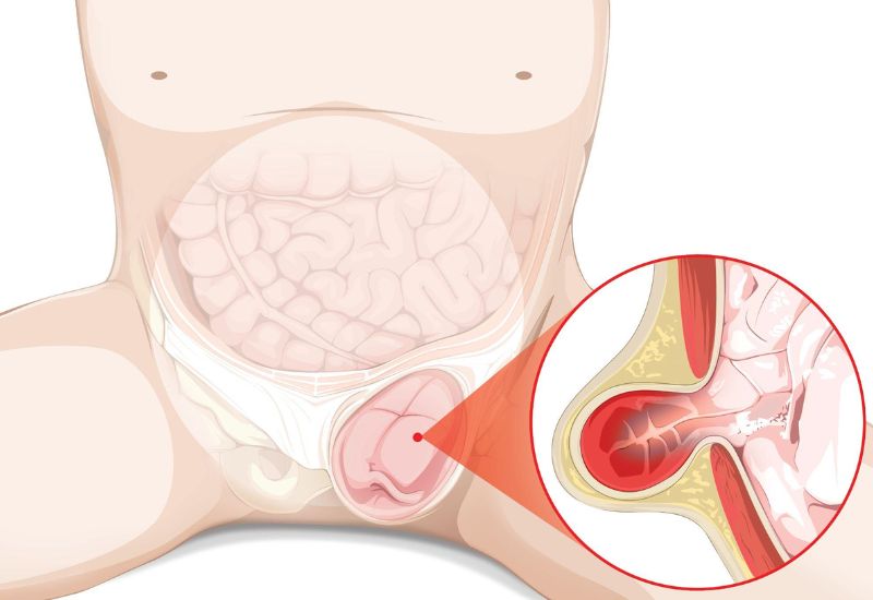 thoát vị bẹn nghẹt có thể gây vô sinh