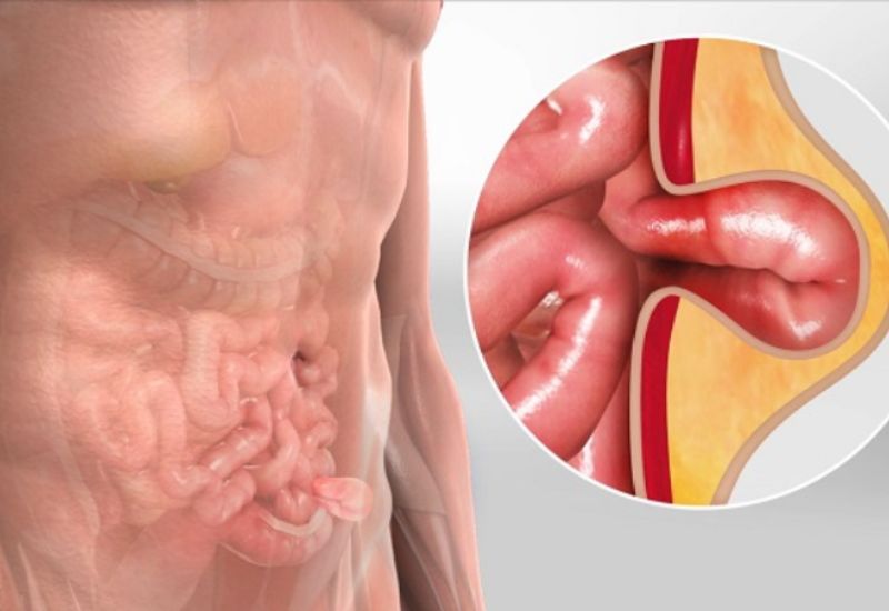 thoát vị bẹn nghẹt