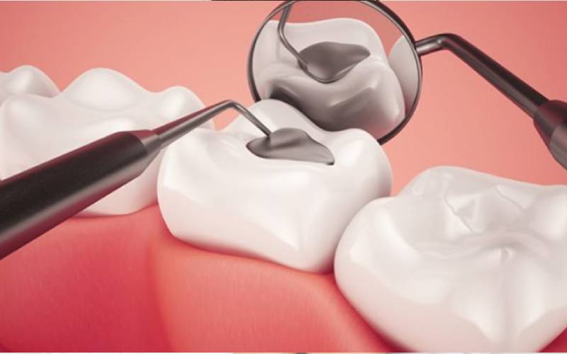 hình ảnh minh họa trám răng sâu lỗ nhỏ