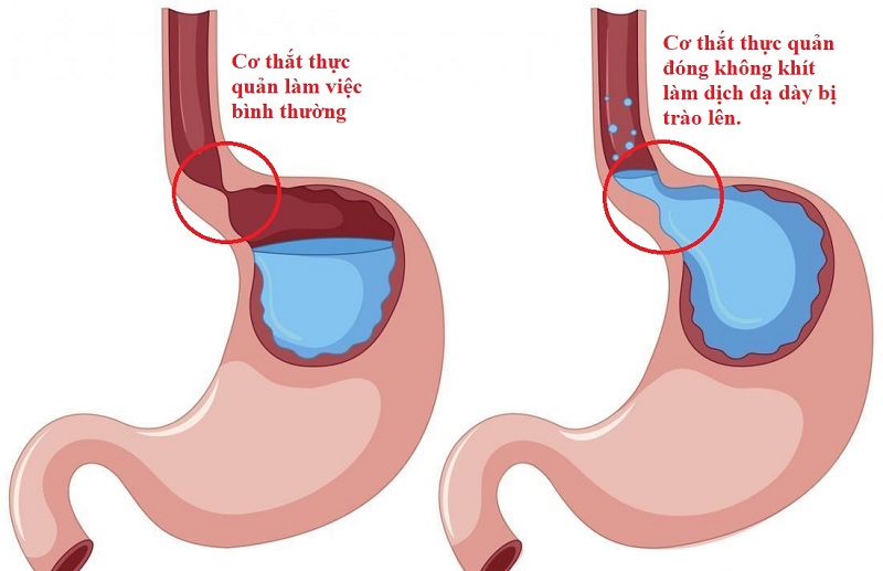 Tìm hiểu chung về chứng trào ngược axit dạ dày