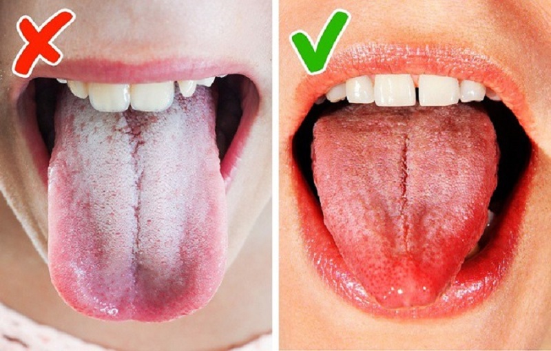 Trào ngược dạ dày lưỡi trắng là tính trạng xuất hiện lớp rêu trắng dày trên bề mặt lưỡi 