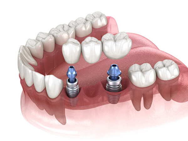 Trồng răng sứ giúp chức năng ăn nhai được khôi phục.