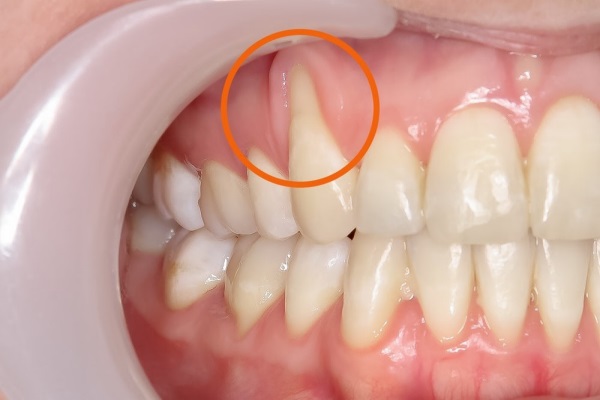 Có nhiều nguyên nhân chính gây ra tình trạng tụt lợi viêm nướu.