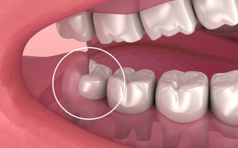 Bảng giá nhổ răng khôn đắt không
