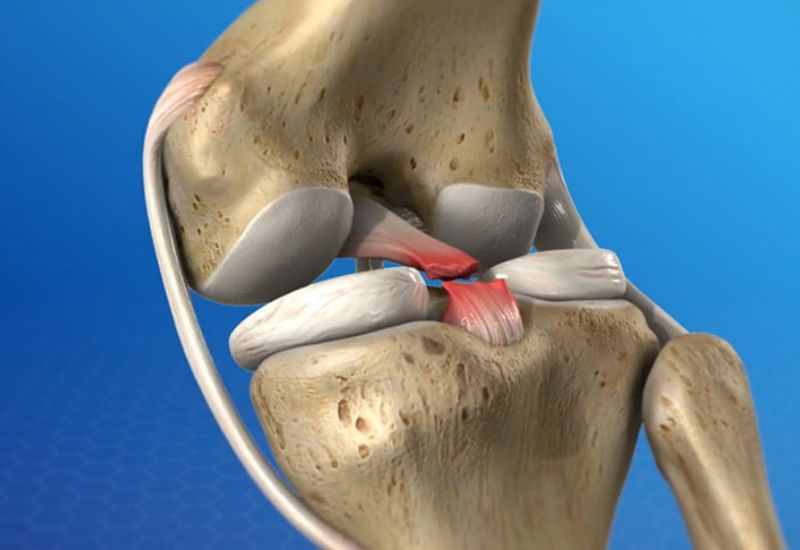 hậu quả do trật khớp gây ra