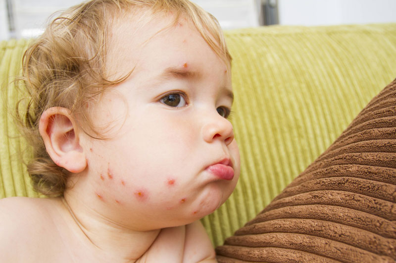 Tuy hiếm nhưng biến chứng của thủy đậu khá nguy hiểm.