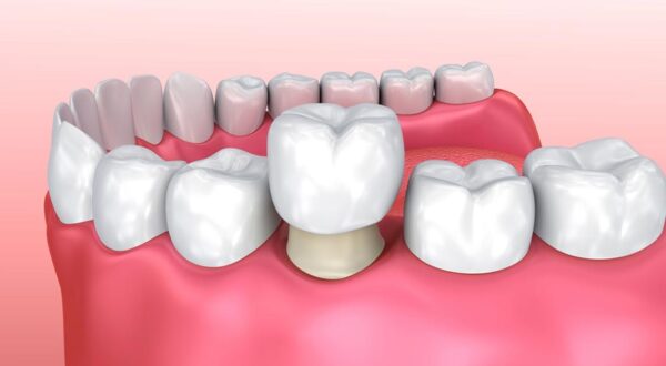 Bọc răng sứ có thể cải thiện nhiều vấn đề về sức khỏe răng miệng.