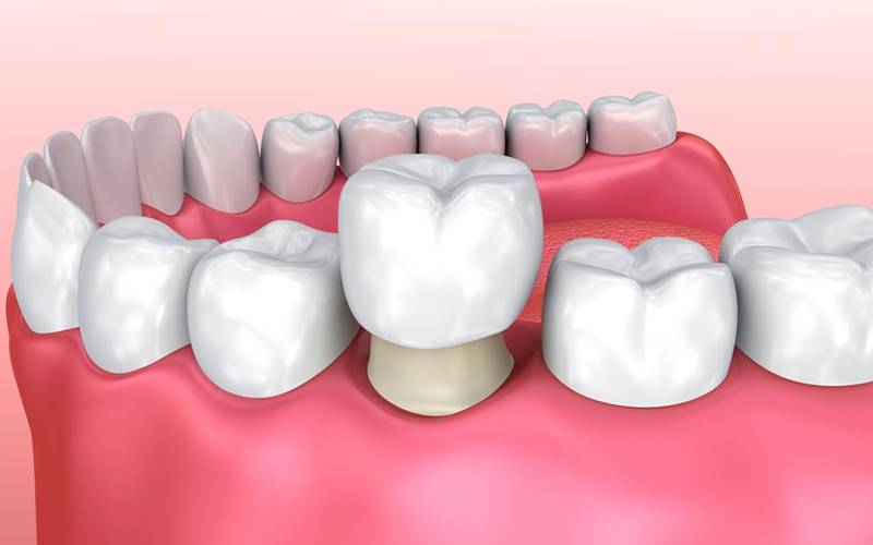 hỏi bọc răng sứ giá bao nhiêu 1 chiếc