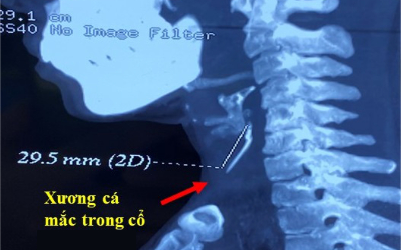 Cách lấy xương cá đâm vào họng của bác sĩ