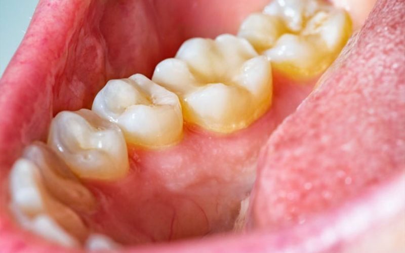 cạo vôi và tẩy trắng răng ở đâu