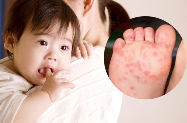 Triệu chứng đặc trưng của bệnh là các nốt đỏ.
