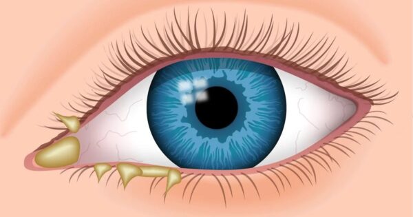 Tắc ống lệ có thể khiến mắt ra nhiều ghèn nhưng không phải loại đau mắt đỏ thường thấy.