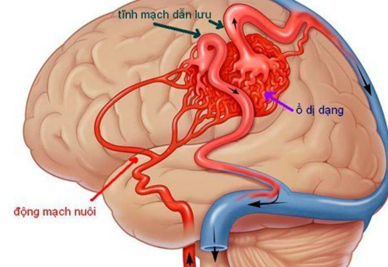 dị dạng mạch máu não