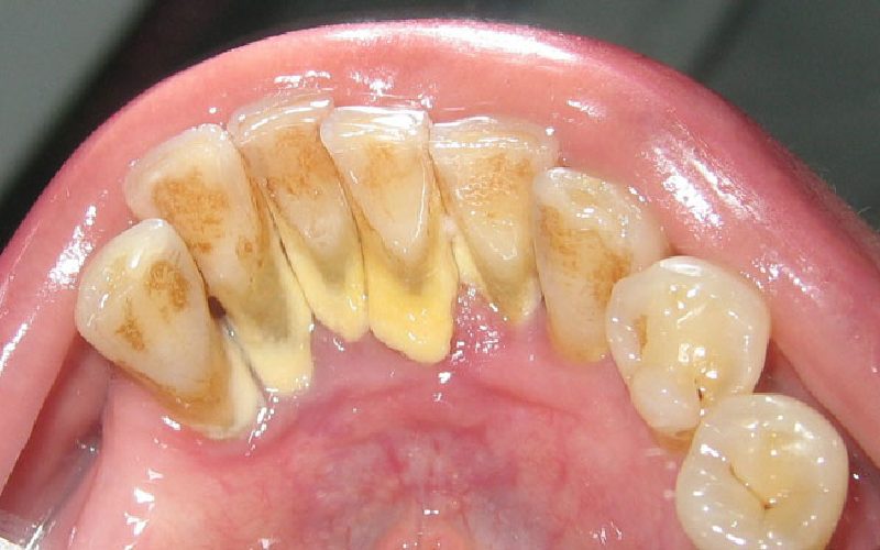 làm sạch cao răng tự nhiên như thế nào