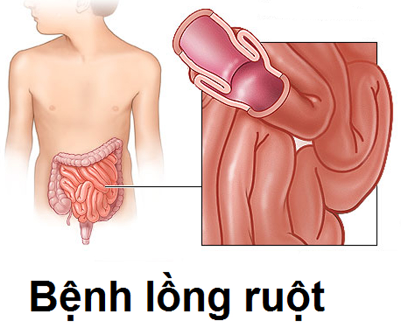 Các bất thường cấu trúc của ruột, như khối u, polyp hoặc các túi thừa, có thể làm tăng nguy cơ lồng ruột.