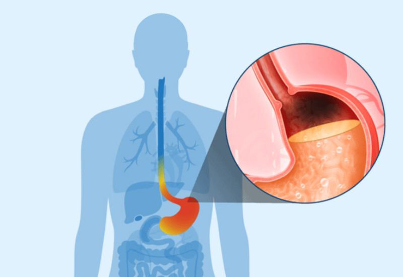 Cách phân biệt đau thượng vị do trào ngược và đau do tim