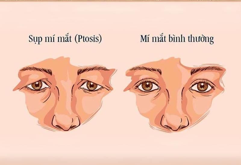 Tùy nguyên nhân sụp mí là gì mà phương án phẫu thuật sẽ khác nhau.