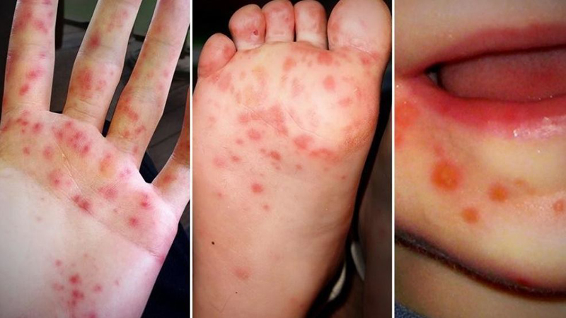 Triệu chứng đặc trưng của bệnh tay chân miệng là những nốt ban ở 3 khu vực này.