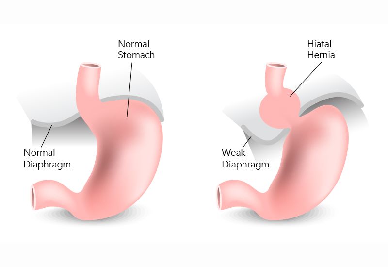 Ợ nóng sau khi ăn: Dấu hiệu của bệnh lý tiêu hóa?