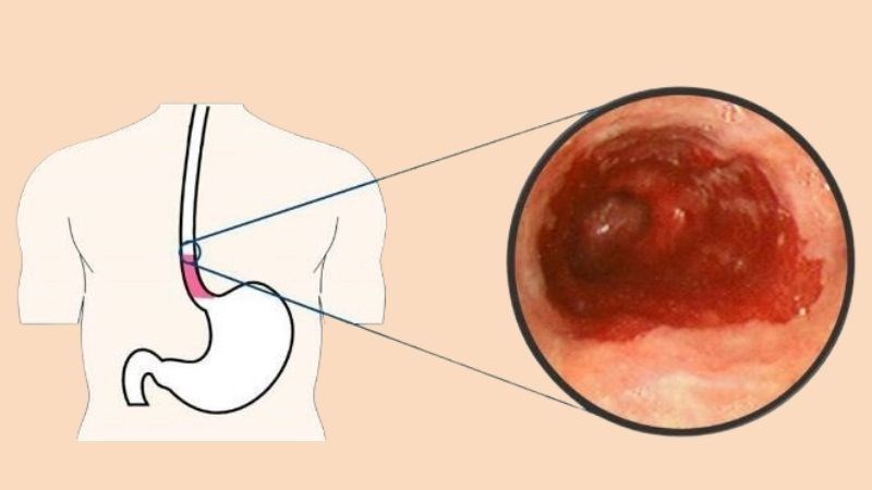 Nguyên nhân gây ợ hơi nhiều sau khi uống rượu bia và tác động đến sức khỏe