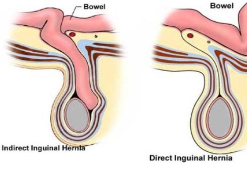 nguyên nhân và triệu chứng thoát vị bẹn