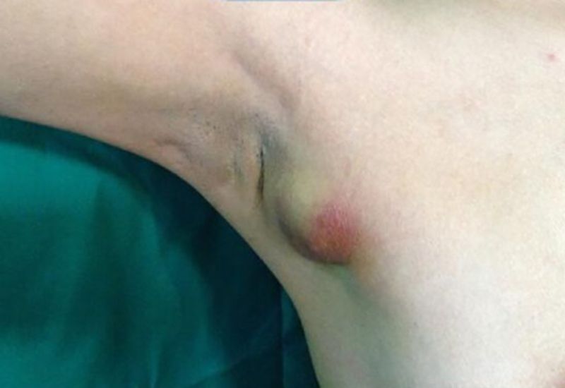 dấu hiệu u mỡ ở nách