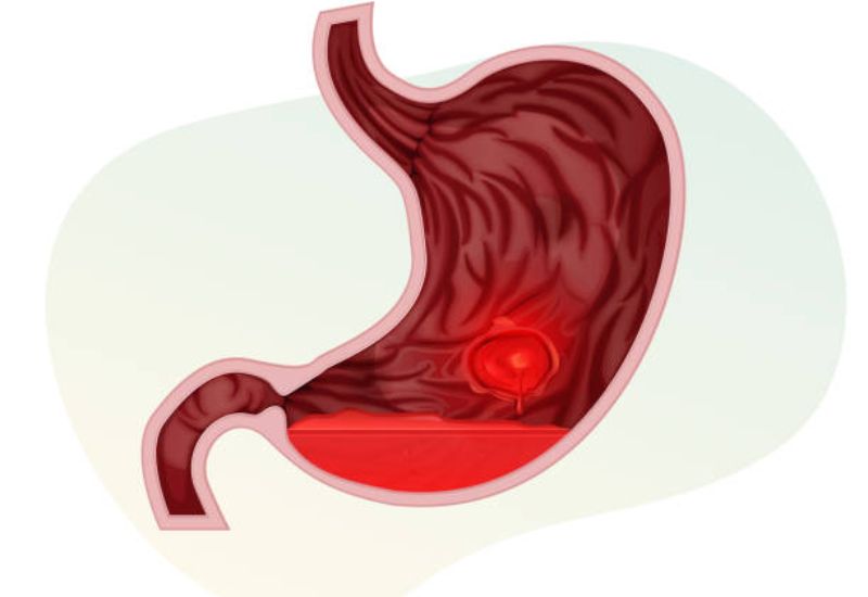 Cơ chế hình thành viêm loét dạ dày và mối liên hệ với ợ chua