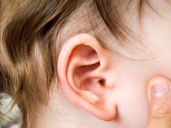 Cấu trúc tai của trẻ em làm tăng nguy cơ bị viêm tai giữa.