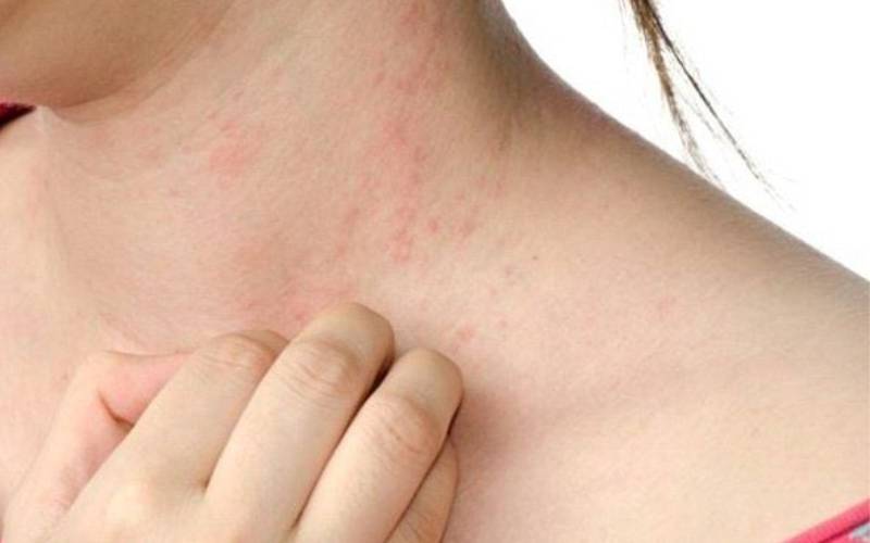 Fexofenadine chữa mề đay