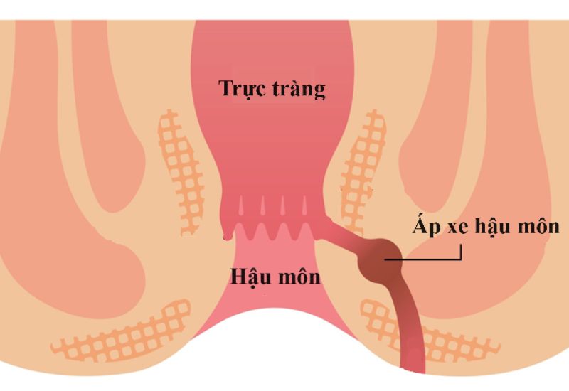 biểu hiện của áp xe và cách điều trị
