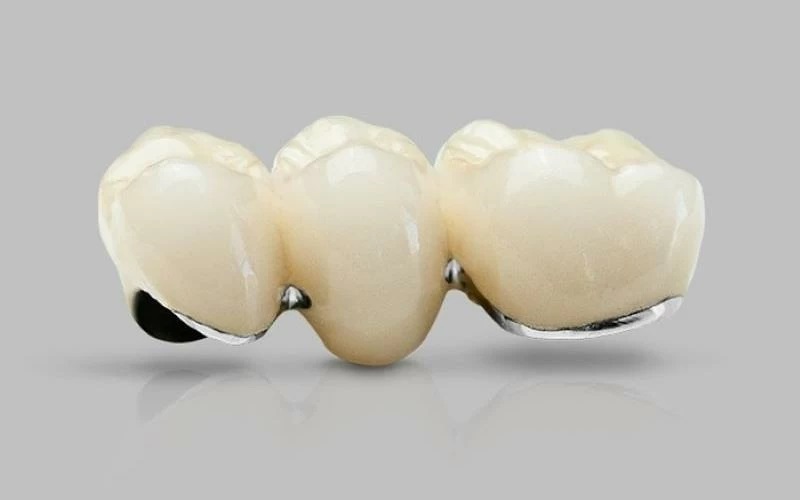 Răng sứ kim loại có giá thành thấp nhưng tính thẩm mỹ không cao.