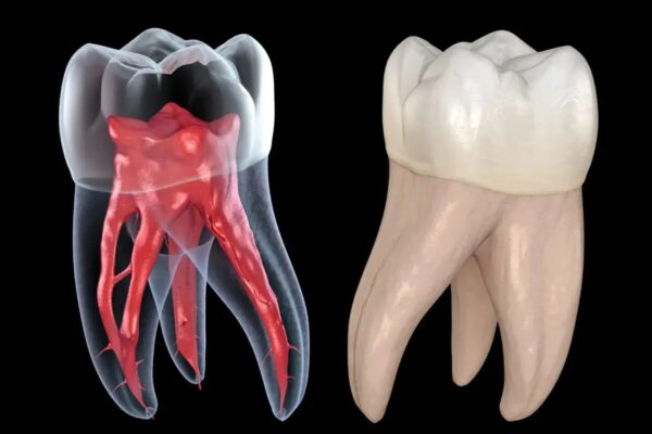 Sau lấy tủy răng sẽ yếu hơn nên cần một lớp bảo vệ mới bên ngoài.