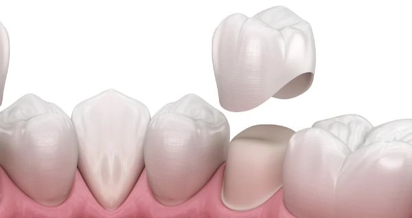 Răng toàn sứ có tính thẩm mỹ cao nhất nhưng chi phí cũng cao hơn răng kim loại.