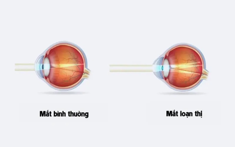 Hình dạng thủy tinh thể không đều dẫn đến loạn thị