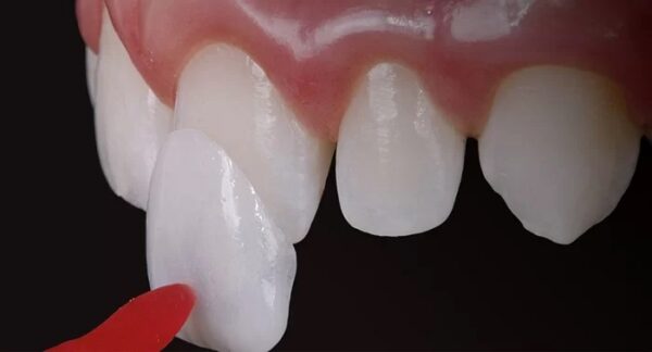 Dán sứ là phương án để cải thiện màu sắc răng rất tốt.