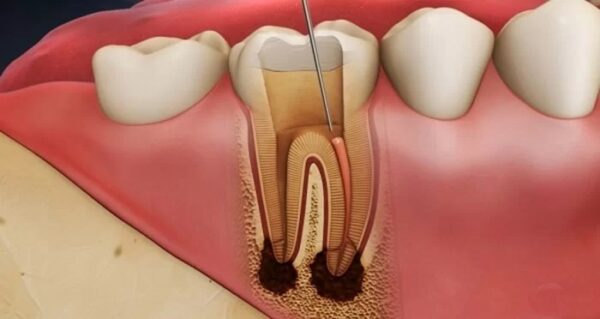 Điều trị tủy răng giúp bảo tồn răng tự nhiên, tránh phải nhổ bỏ răng và thay thế bằng răng giả.