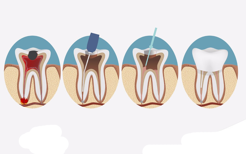 Chi phí điều trị tủy răng có thể biến động đáng kể tùy thuộc vào nhiều yếu tố khác nhau.