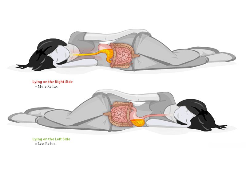 Trào ngược dạ dày thực quản (GERD) gây khó nuốt khi ngủ