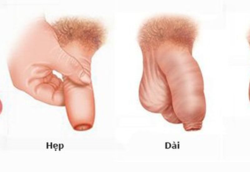 triệu chứng hẹp bao quy đầu